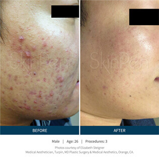 Before and after microneedling procedure #1