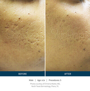 Before and after microneedling procedure #2