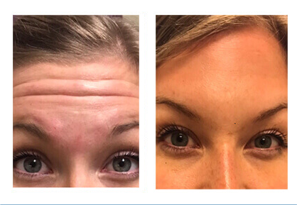 Real patient #3 before and after photo Botox® procedure on the forehead
