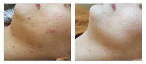 Delivering the results for Acne treatment