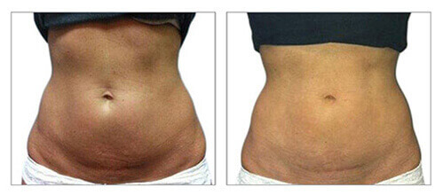 Delivering the results for body contouring procedures