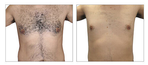 Delivering the results for hair removal