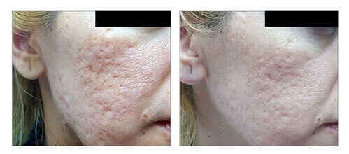 Delivering the results for skin resurfacing