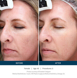 Before and after microneedling procedure #3