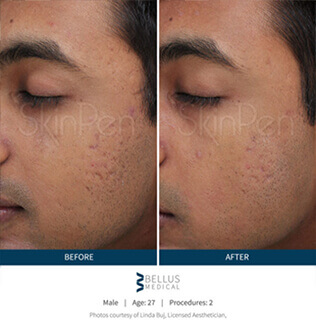 Before and after microneedling procedure #4