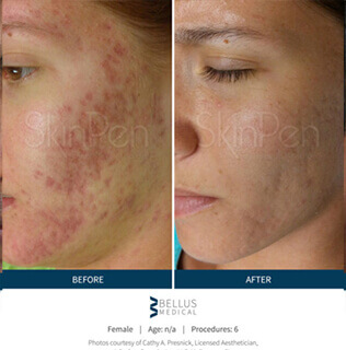 Before and after microneedling procedure #5