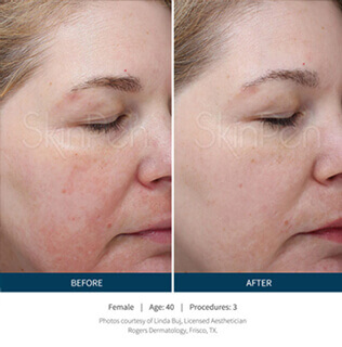 Before and after microneedling procedure #6