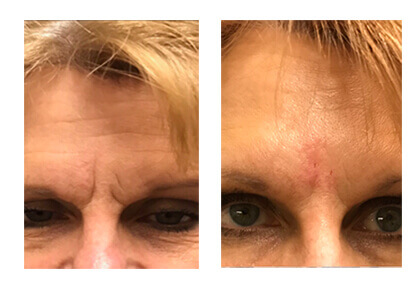 Real patient #2 before and after photo Botox® procedure on the forehead