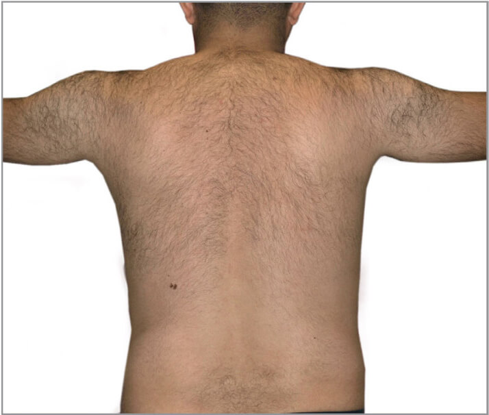 Male back hair removal before photo