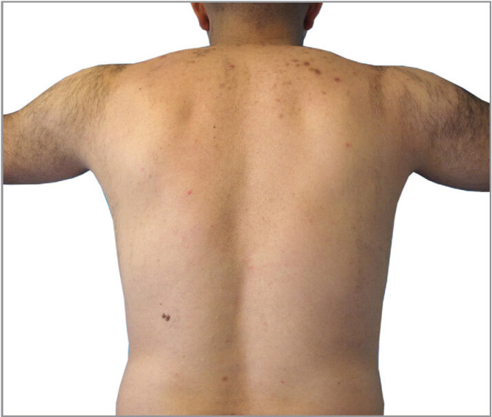Male back hair removal after photo