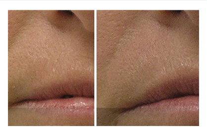 Nasolabial folds 5 sessions - before and after photos
