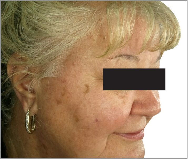 Facial skin rejuvenation before photo