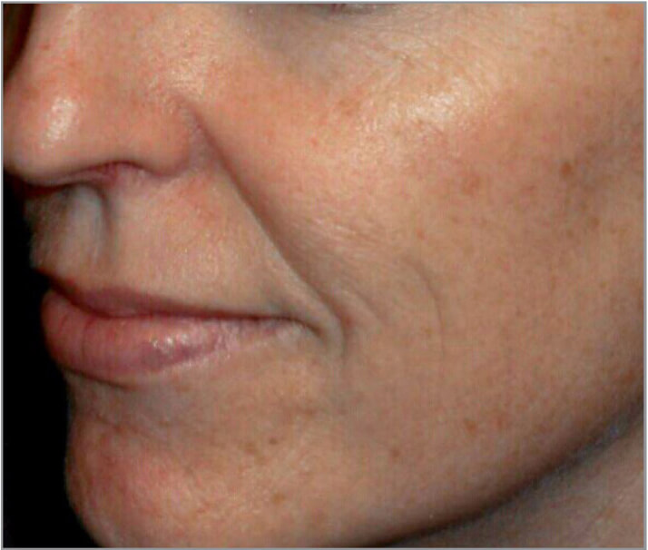 Laser wrinkle reduction before photo