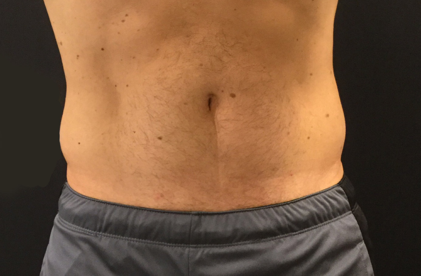 Real patient #1 Coolsculpting procedure after photo