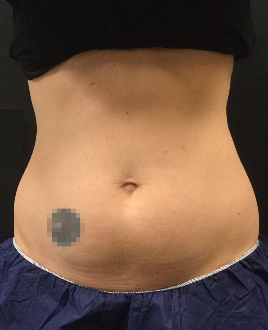 Coolsculpting Patient Before