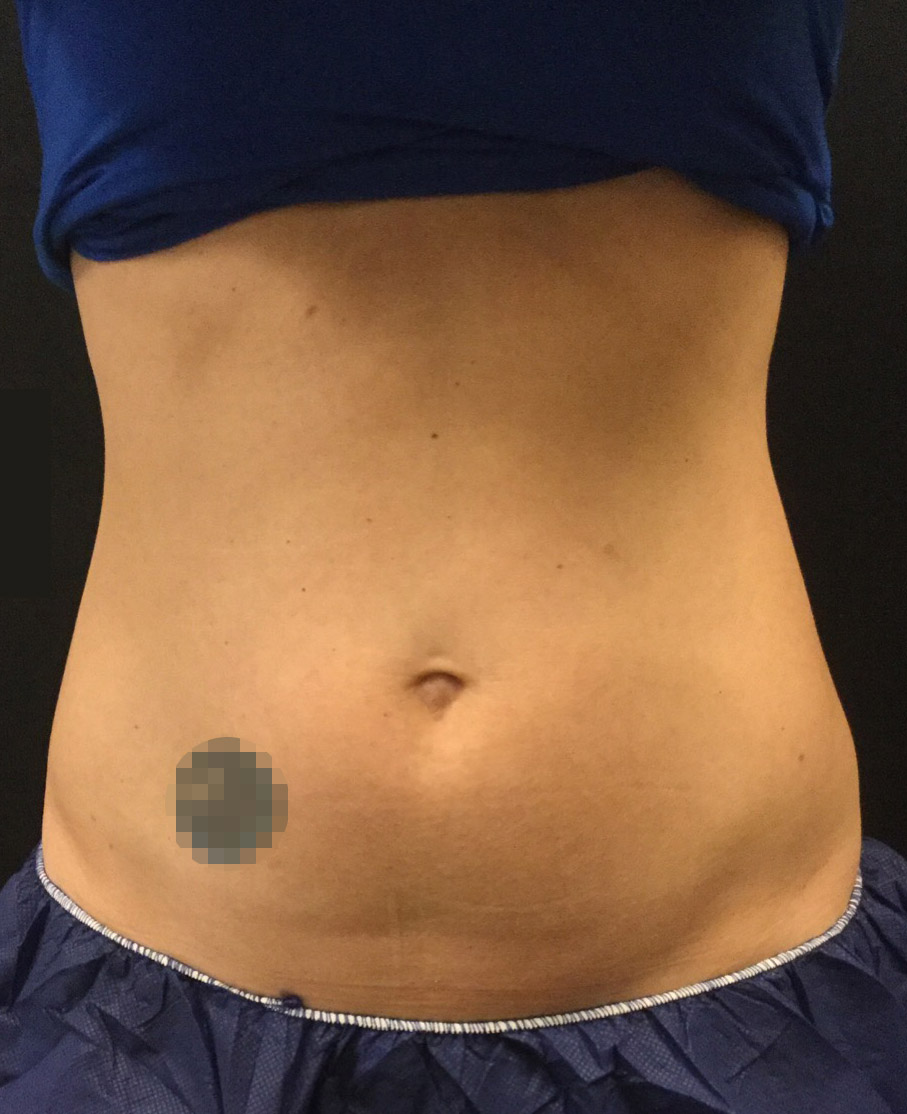 Real patient #2 Coolsculpting procedure after photo