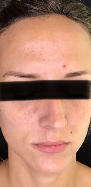 Halo Hybrid Laser Patient Before