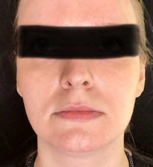 Botox® real patient before photo showing wrinkles around face