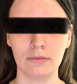 Botox® real patient after photo showing smooth skin around face