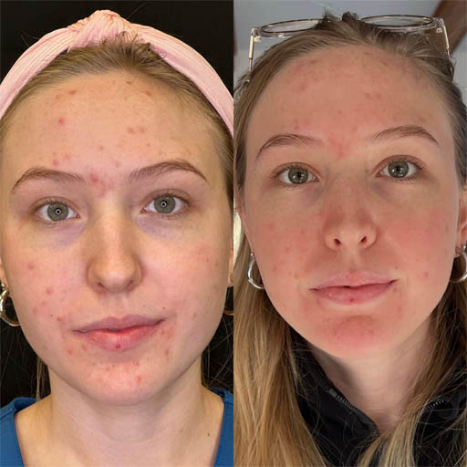 1_0000_skinpen.jpg
