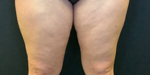 Coolsculpting