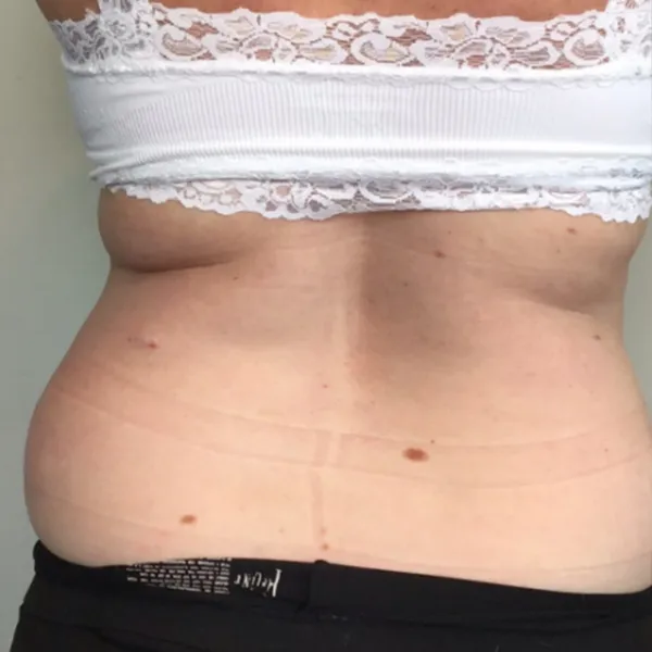 coolsculpting_4-6-1000×1000-after