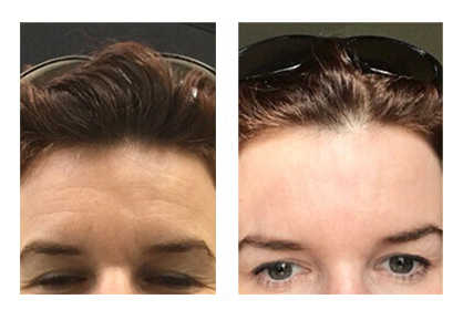 Real patient #1 before and after photo Botox® procedure on the forehead