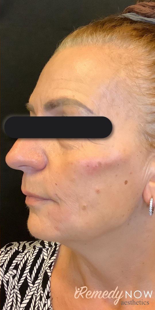 dermal fillers 2_0000_Layer 0 copy