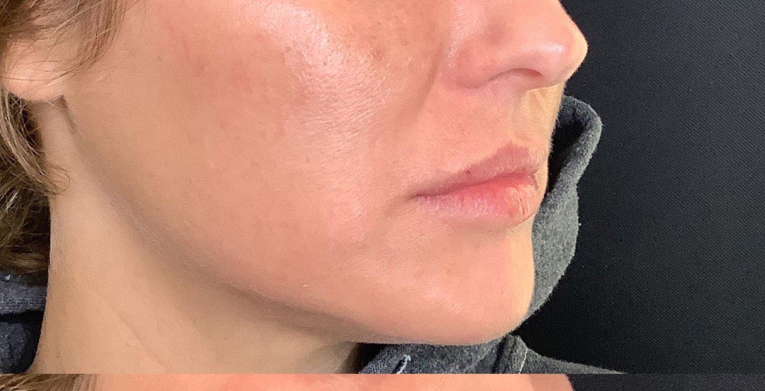 lip fillers 1_0000_Layer 0 copy
