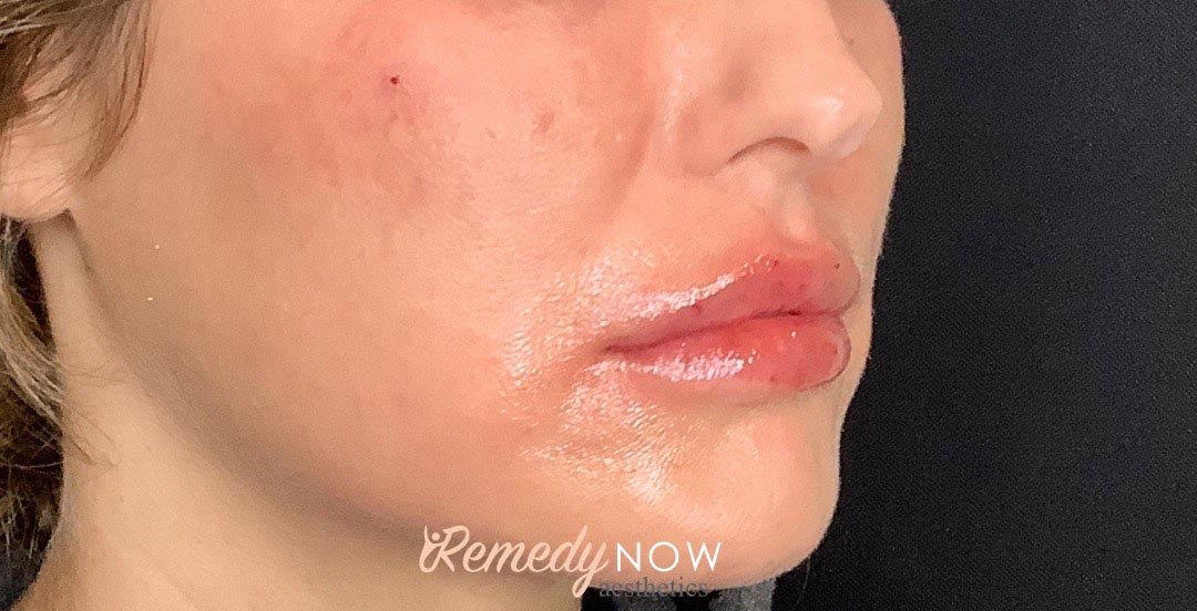 lip fillers 1_0001_Layer 0