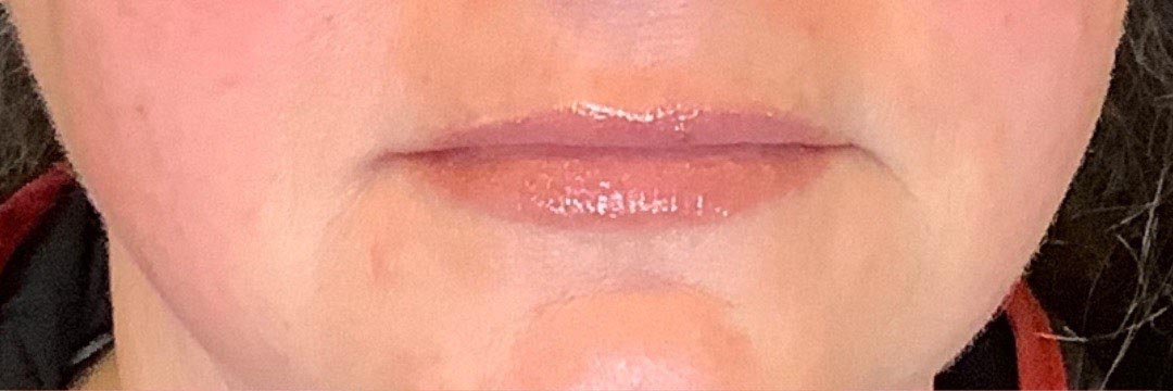 lip fillers 3_0000_Layer 0 copy