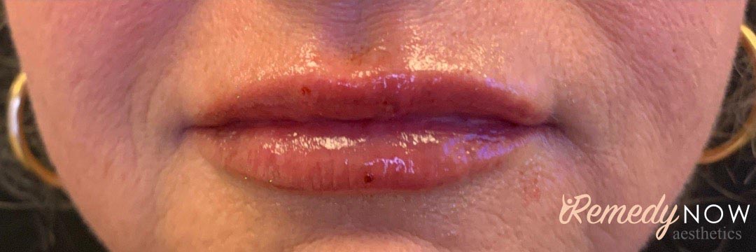lip fillers 3_0001_Layer 0