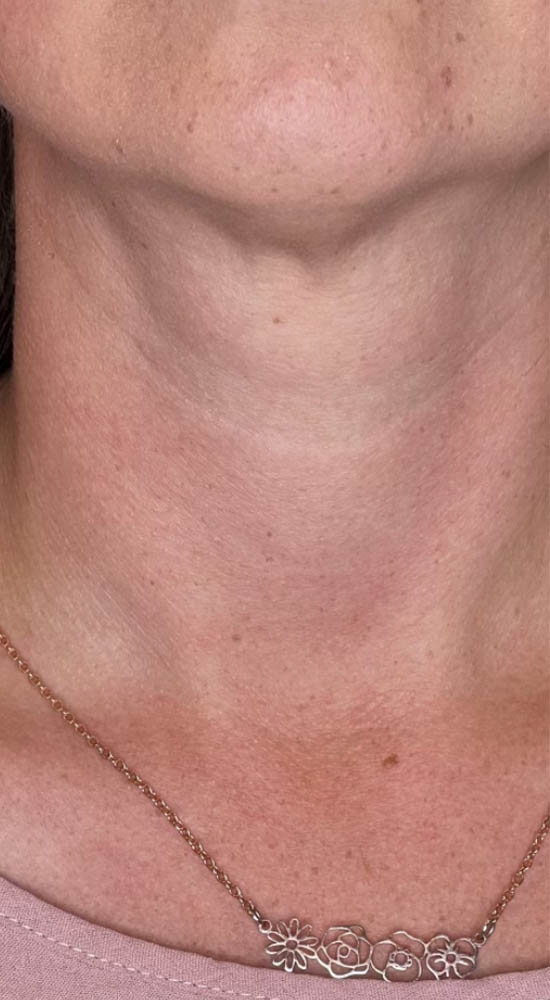 RF MICRONEEDLING B&A’S – 2