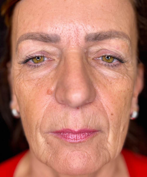 BLANK BELLAFILL B&A’S – 4