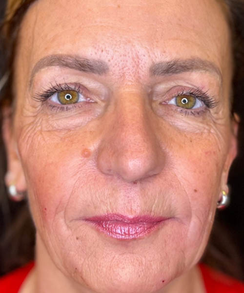 BLANK BELLAFILL B&A’S – 4