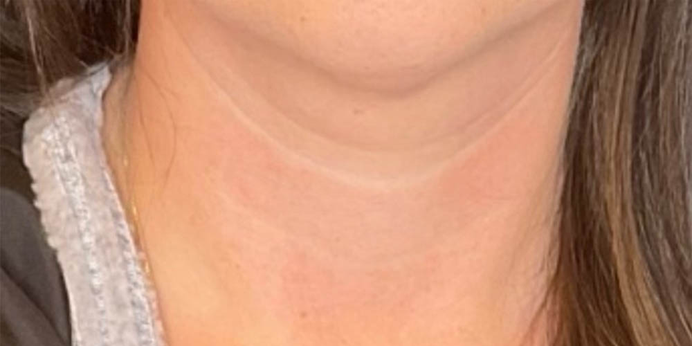 RF MICRONEEDLING B&A’S – 2