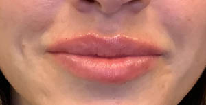 BLANK LIP FILLER B&A’S – 10