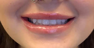 BLANK LIP FILLER B&A’S – 10