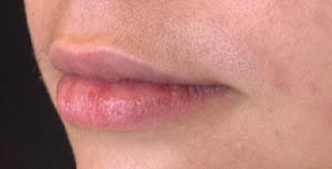 BLANK LIP FILLER B&A’S – 10