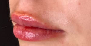 BLANK LIP FILLER B&A’S – 10