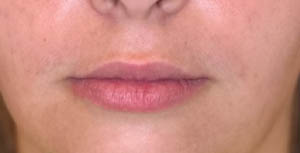 BLANK LIP FILLER B&A’S – 10