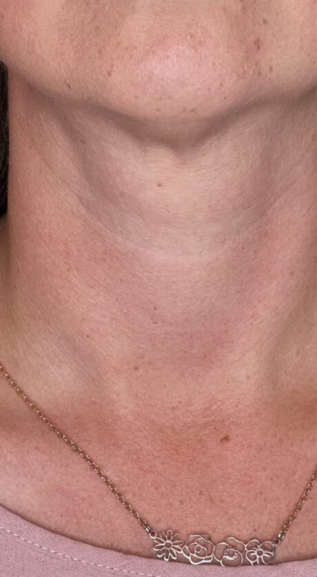 RF MICRONEEDLING B&A’S – 2