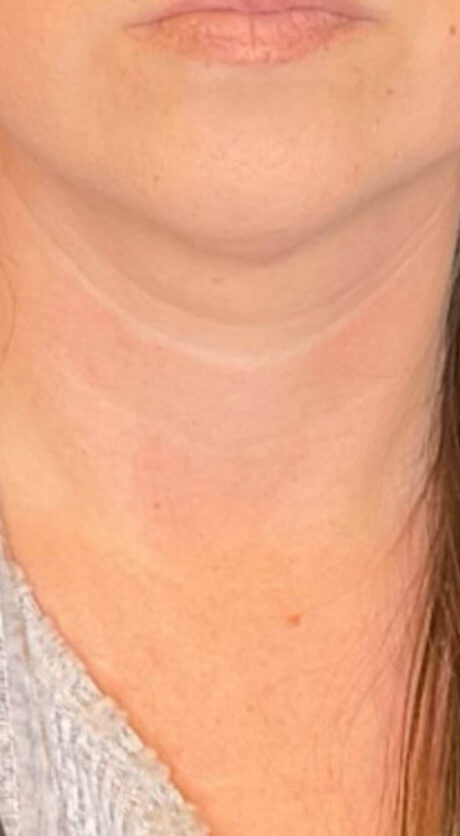 RF MICRONEEDLING B&A’S – 2
