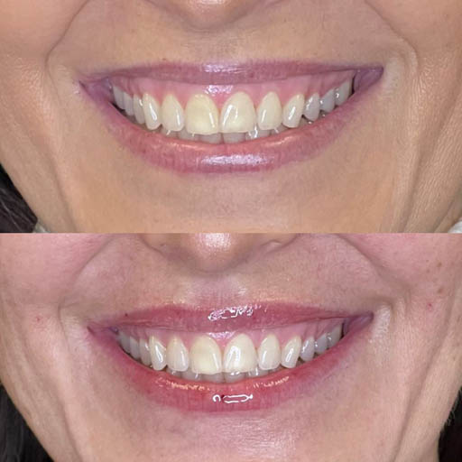 1_0000_LIP FILLER_Page_02_Image_0001.jpg
