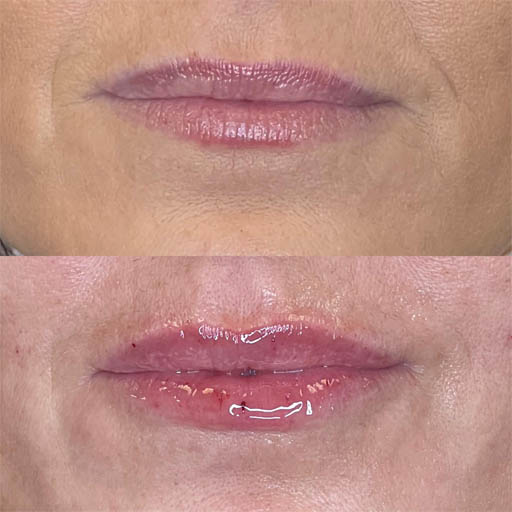 1_0001_LIP FILLER_Page_02_Image_0002.jpg