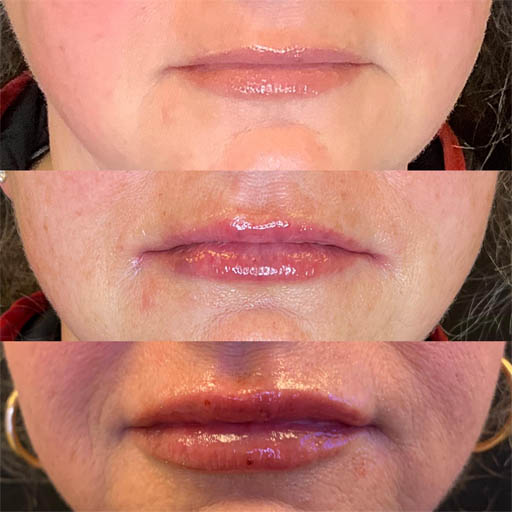 1_0002_LIP FILLER_Page_03_Image_0001.jpg