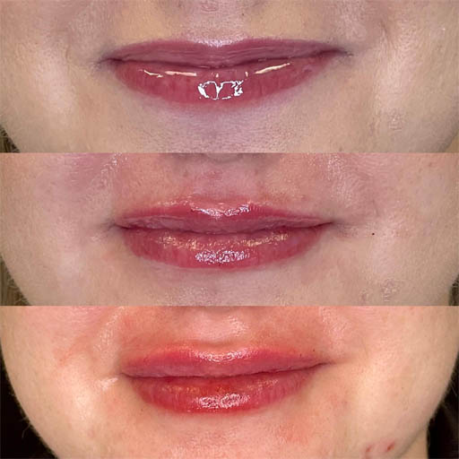 1_0003_LIP FILLER_Page_04_Image_0001.jpg