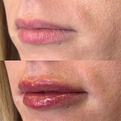 1_0005_LIP FILLER_Page_05_Image_0001.jpg