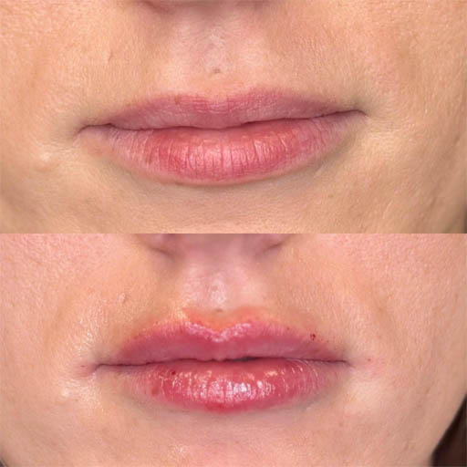 1_0006_LIP FILLER_Page_05_Image_0002.jpg