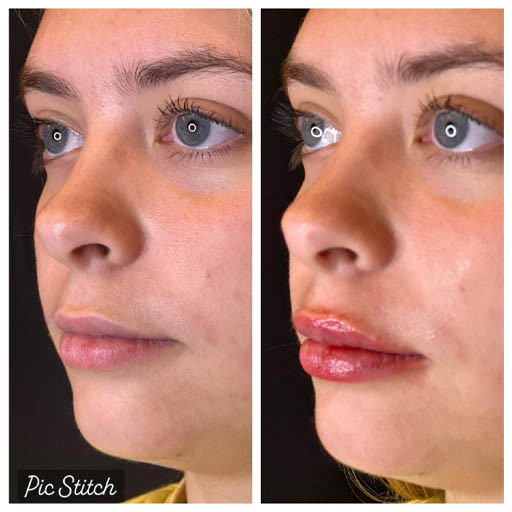 1_0012_LIP FILLER_Page_09_Image_0001.jpg